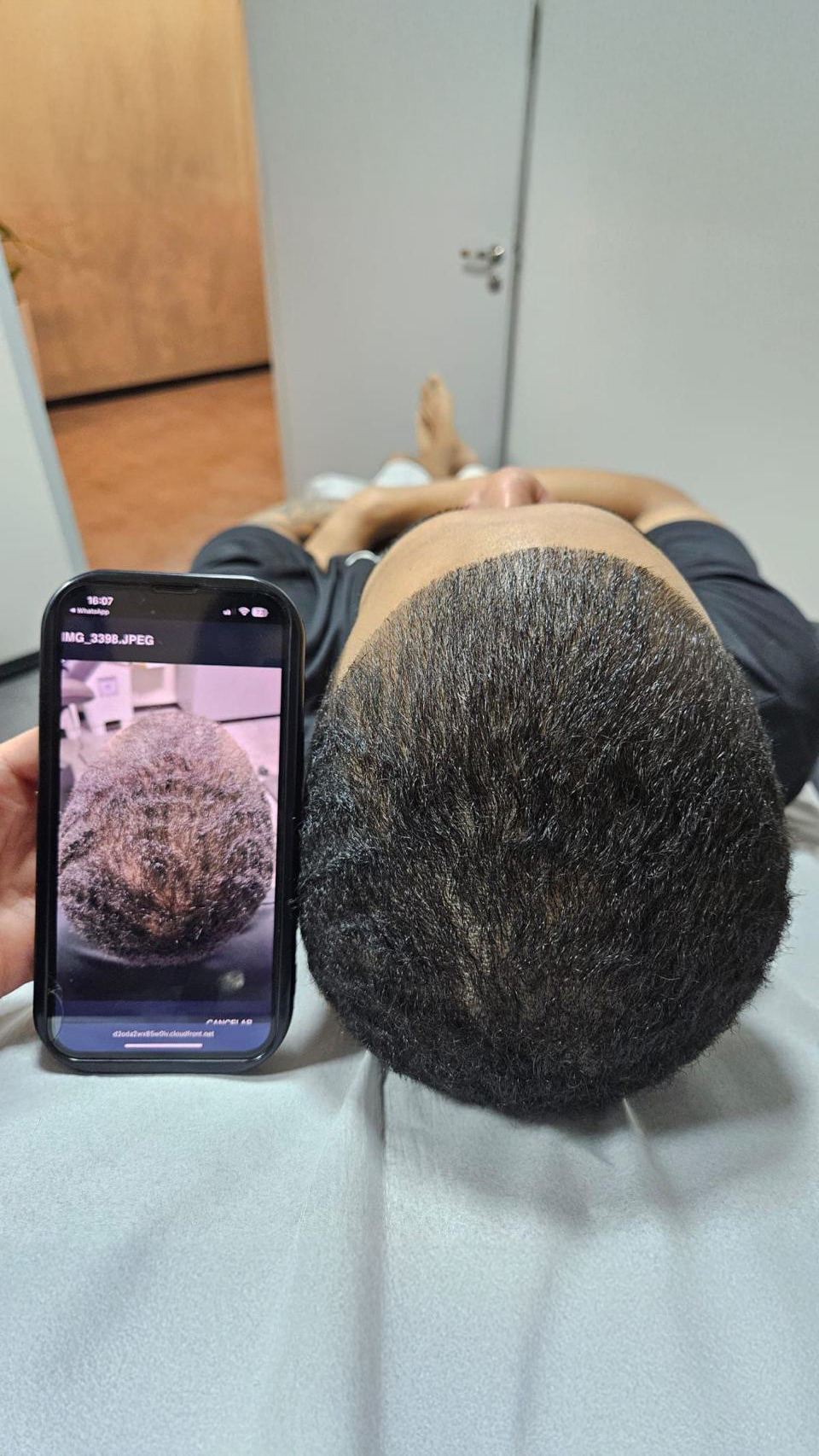 Resultado real de paciente Dr Hair